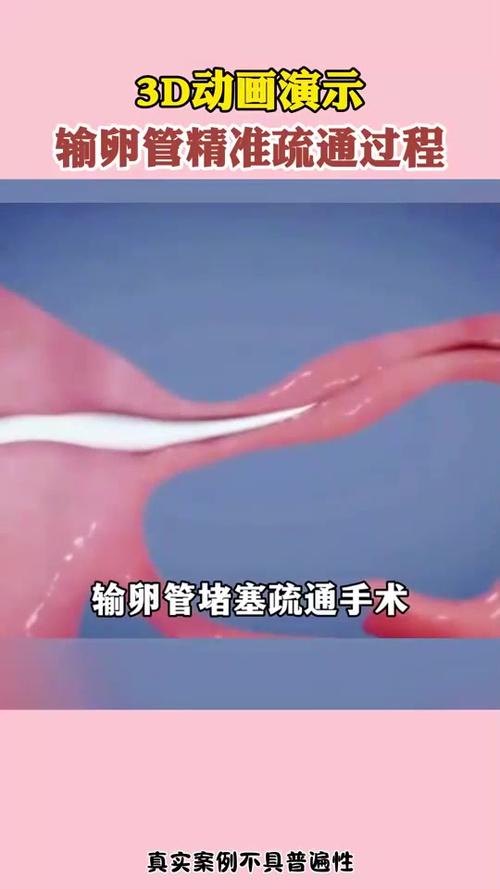 输卵管堵塞了怎么疏通游戏截图
