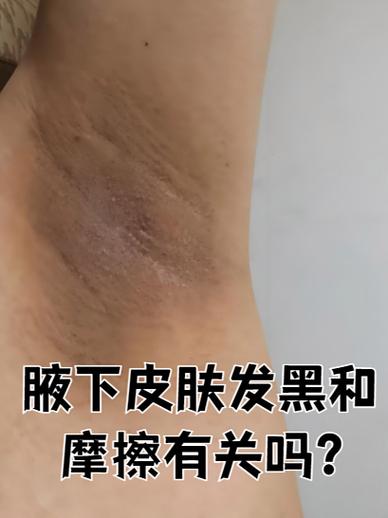 腋窝变黑是什么原因缩略图