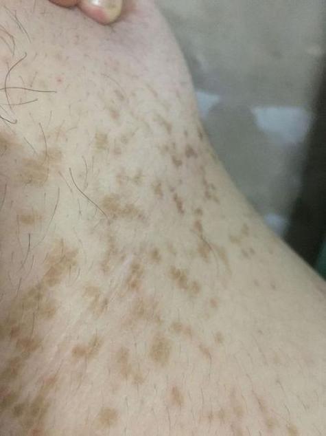 皮肤黑斑的10个图片缩略图