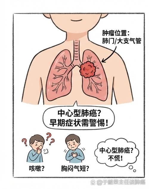 肺部肿瘤怎么治疗效果最好缩略图