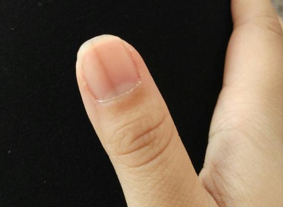 指甲上有黑色竖纹缩略图