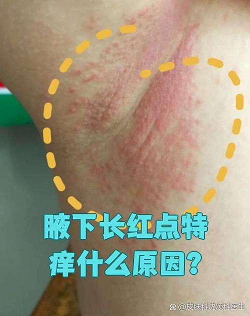 腋下有疙瘩痒怎么回事缩略图