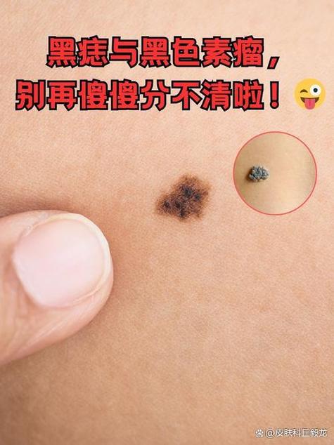 看黑痣挂什么科游戏截图