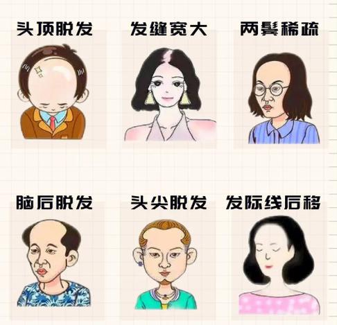 脱发去医院挂什么科缩略图