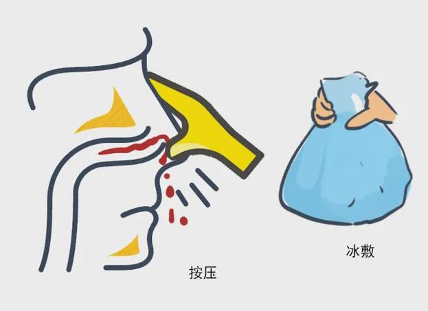 流鼻血的土方法治疗缩略图