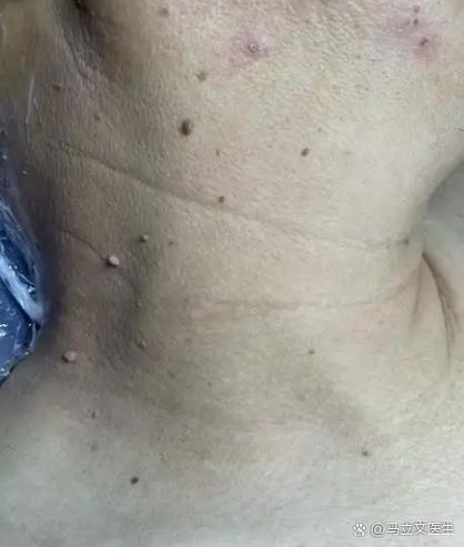 手臂里面摸到个圆球硬疙瘩缩略图