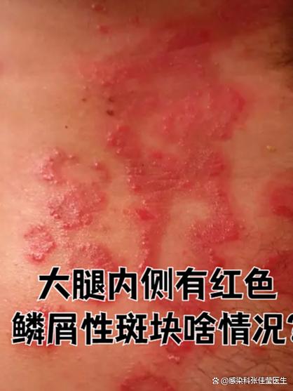皮肤上出现红色圆形斑块游戏截图