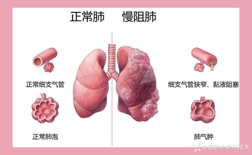 肿气肿有哪些症状缩略图