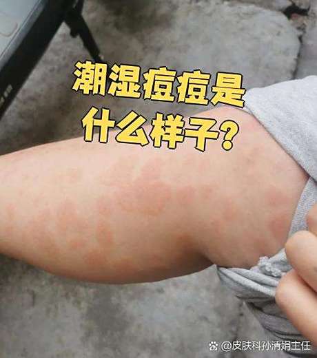湿毒起疙瘩图片游戏截图