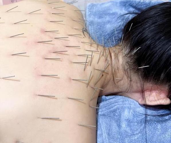 浑身像小针尖扎一样缩略图