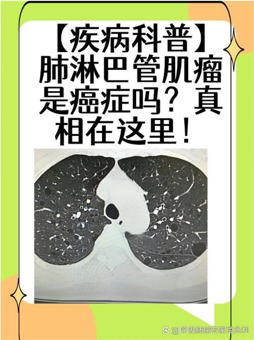 肺上长了肿瘤能治好吗缩略图
