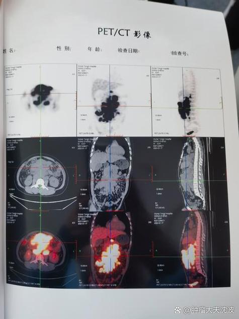 人一旦做petct就意味着什么缩略图