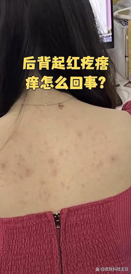 后背起红疙瘩很痒缩略图