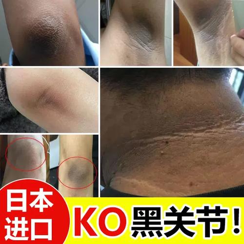 腋下黑是什么原因导致的缩略图