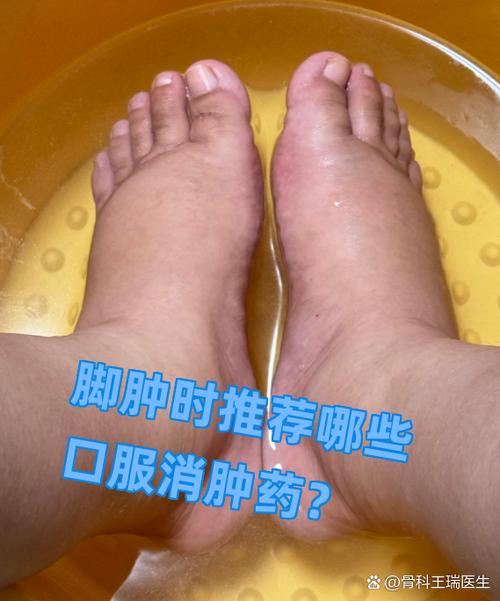 脚肿吃什么药消肿缩略图