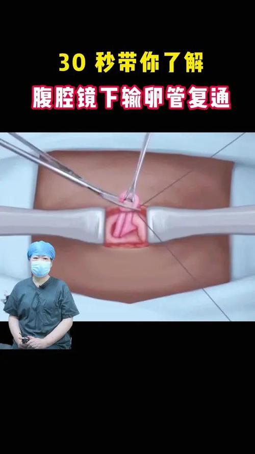 输卵管复通术大概要多少钱缩略图
