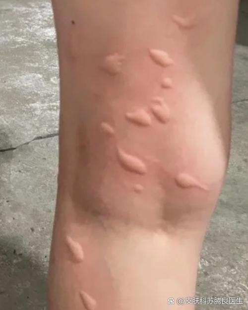 身体痒越抓越痒还起疙瘩怎么回事缩略图