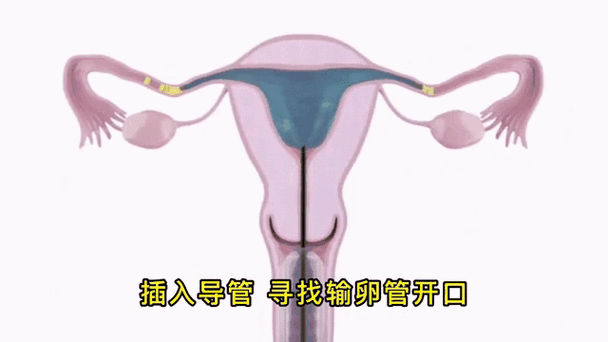怎么疏通输卵管缩略图