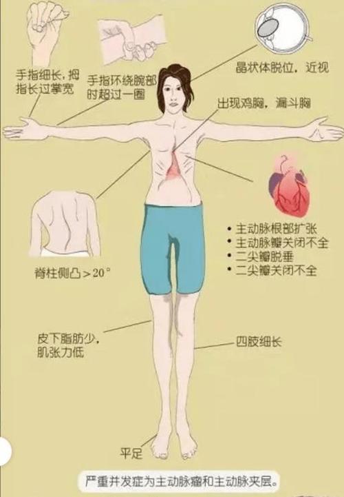 mfs医学上是什么意思缩略图
