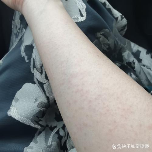 为什么腿上会长出红疙瘩缩略图