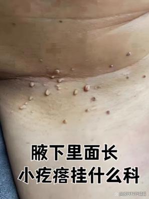腋下有疙瘩缩略图