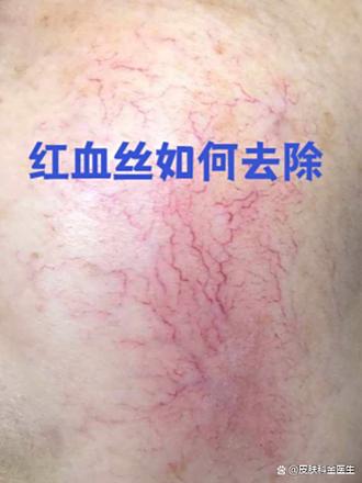 脸上红血丝怎么去除最快方法缩略图
