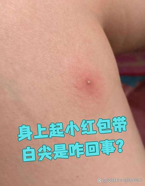 红疙瘩中间有小白点凸起游戏截图