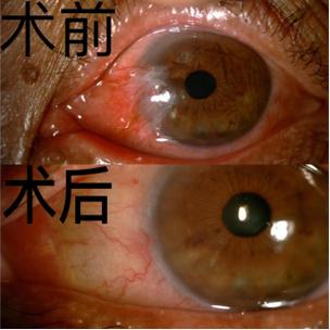 胬肉健康宣教缩略图