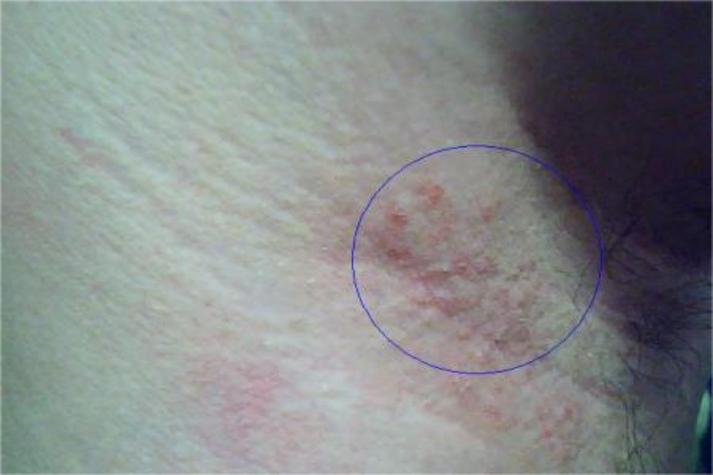 腋下有小疙瘩痒越挠越痒缩略图
