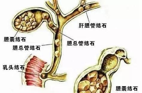 肾结石吃青柠檬还是黄柠檬缩略图