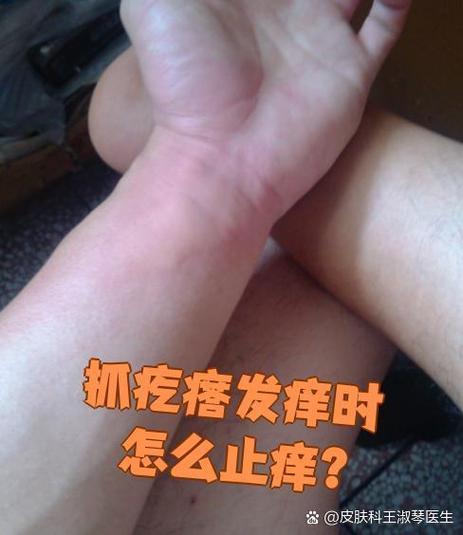 身上忽然起红疙瘩还特别痒缩略图