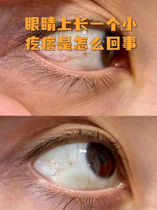 眼睛有一个小疙瘩是怎么回事缩略图