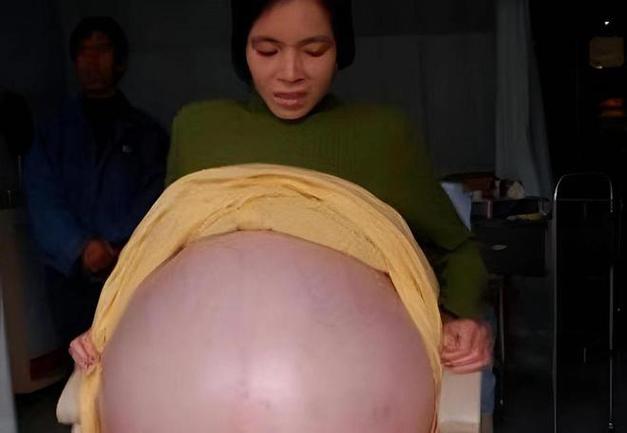 怀孕寄生肚子变大缩略图