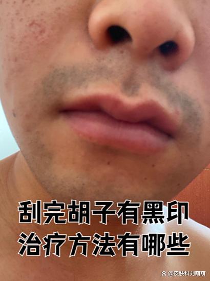 去黑印用什么药膏最好