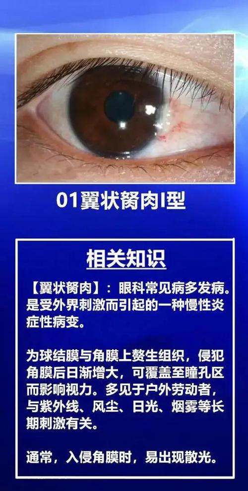 四十岁割眼睛胬肉会复发吗缩略图