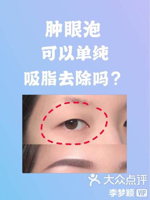 肿眼泡可以只抽脂不割双眼皮吗缩略图