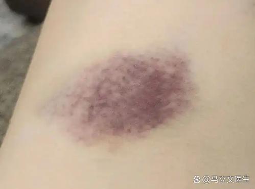 皮肤出现紫红色斑块缩略图