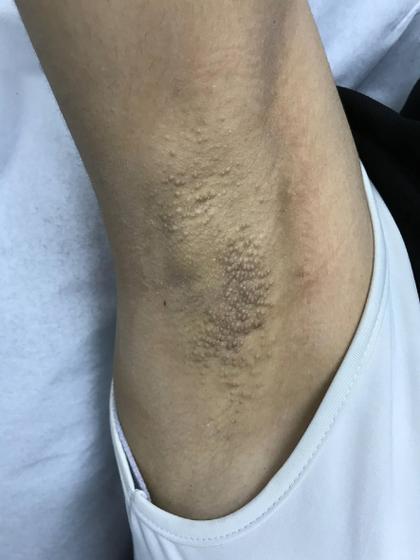 腋窝痒越抓越痒有小疙瘩缩略图