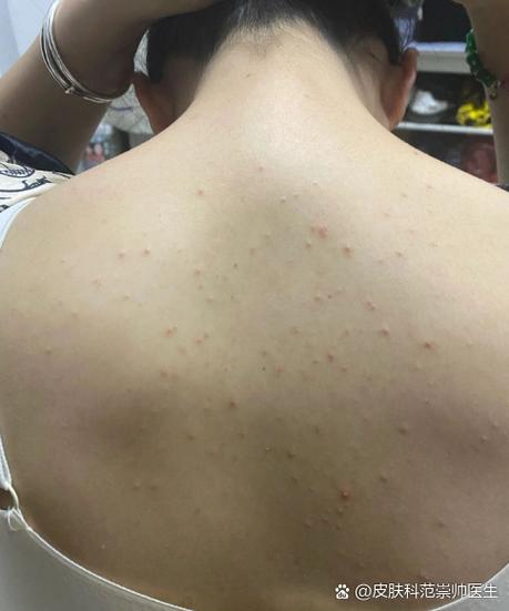 上眼皮翻开长了疙瘩缩略图