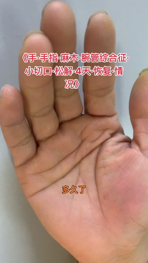 治疗手气的最佳方法缩略图