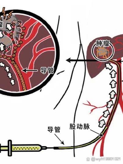 肝介入治疗一次费用多少钱缩略图