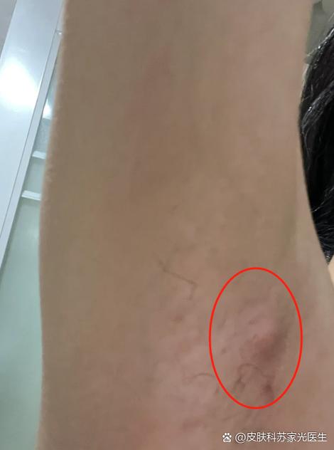 腋下长红疙瘩很痒缩略图