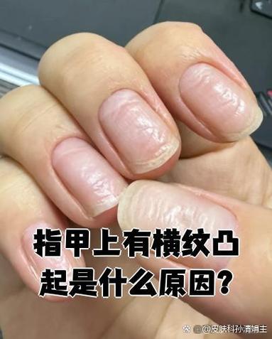 指甲有横条纹缩略图