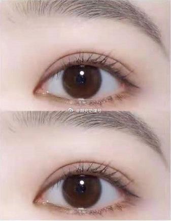 双眼皮缩略图