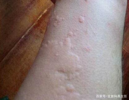 手腕上有个凸起的疙瘩怎么回事缩略图