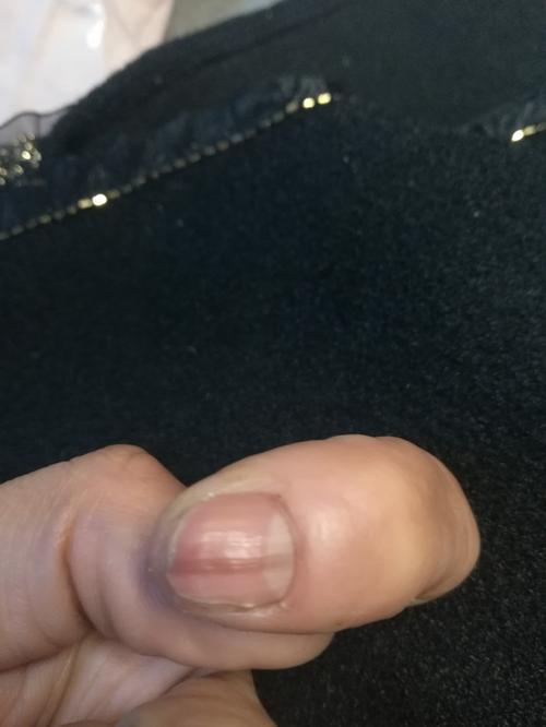 手指有黑色竖纹是不是甲母痣缩略图