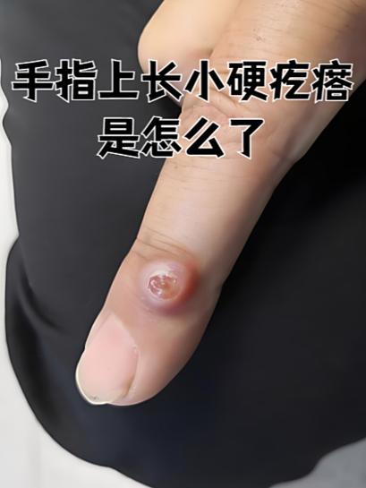 牛牛皮上长个硬硬的小疙瘩缩略图