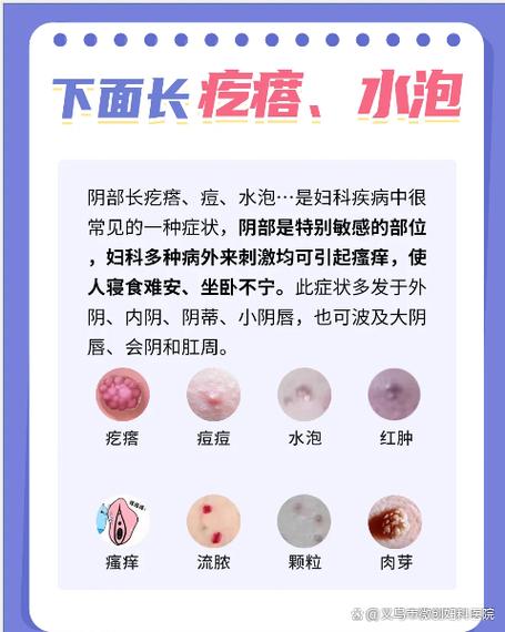 女生隐私地方起了个疙瘩缩略图