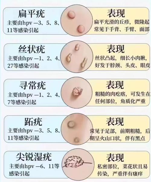 hpv疣是什么样子图片缩略图