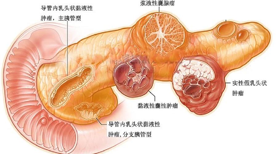 胰腺肿瘤游戏截图
